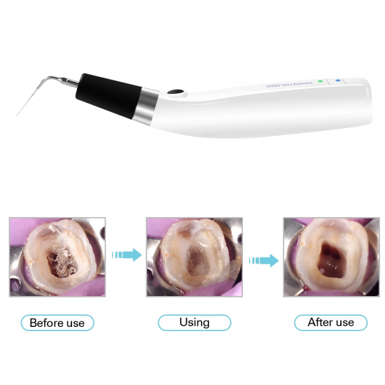 Cordless Endo Ultrasonic Activator – Endo Irrigation Handpiece